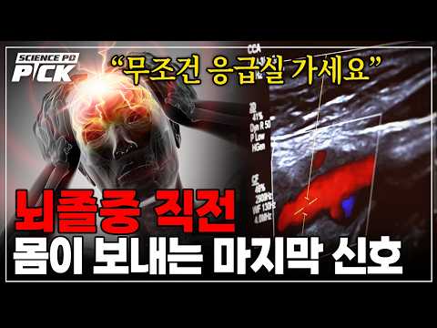 '이 증상' 나타나면 이미 <strong>뇌졸중</strong> 시작됐다? 우리 뇌혈관이 보내는 '위험 신호' [Science PD Pick] / YTN 사이언스
