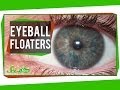 Understanding Eye Floaters