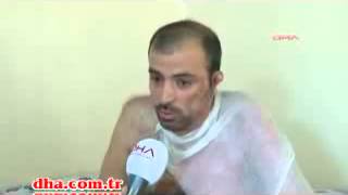 Direkte Yanan Teknisyenin Mucizevi Kurtuluşu