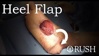 Medial Plantar Artery Flap