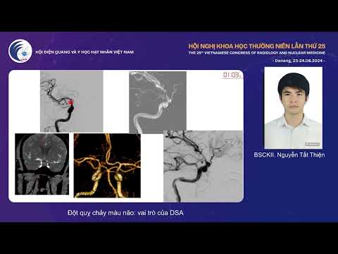 2. Đột quỵ chảy máu não: vai trò của DSA (BS.CKII. Nguyễn Tất Thiện)