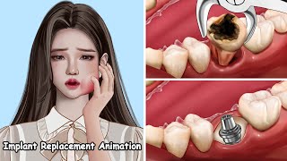 ASMR Implant Replacement Animation - Deep Cleaning Treatment