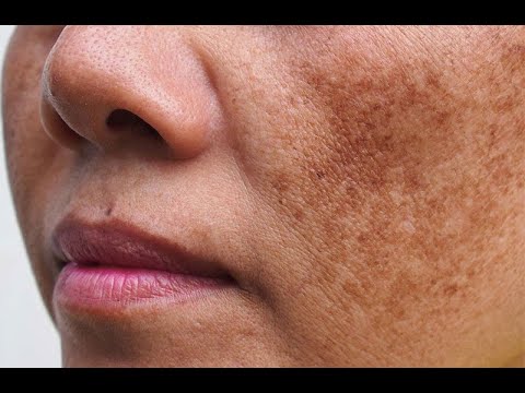 Điều Trị Nám – Trẻ Hóa Da Toàn Diện Cùng Công Nghệ Mới Tại Hoa Anh | Đào Ngọc Anh Clinic