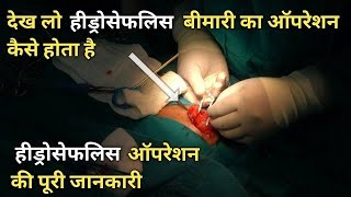 hydrocephalus treatment without surgery | hydrocephalus ka ilaj in hindi | hydrocephalus in hindi