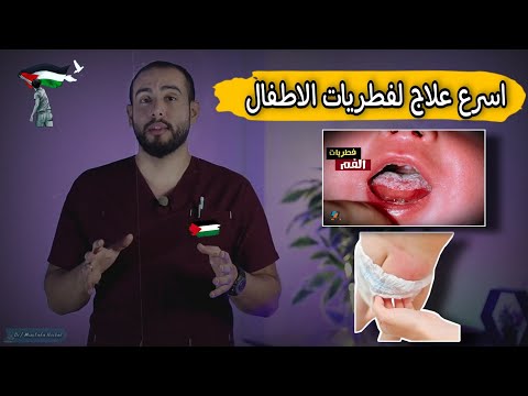 علاج فطريات الفم واللسان عند الاطفال | اسرع علاج لفطريات الاطفال | اسباب فطريات الفم عند الاطفال