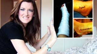 The FULL Story of My Broken Ankle (VIDEOS + PHOTOS | DormRoomDivas