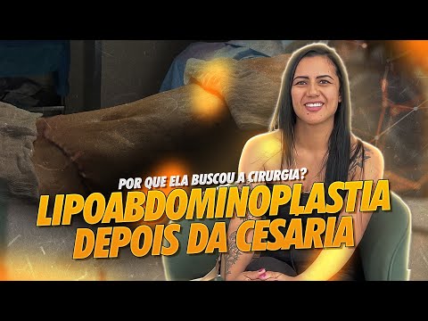 LIPOABDOMINOPLASTIA DEPOIS DA GRAVIDEZ