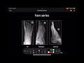 Foot X-Ray Positioning and Views