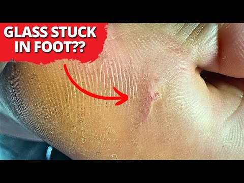 Glass Stuck Deep in Foot For Months — Watch the Satisfying Removal!