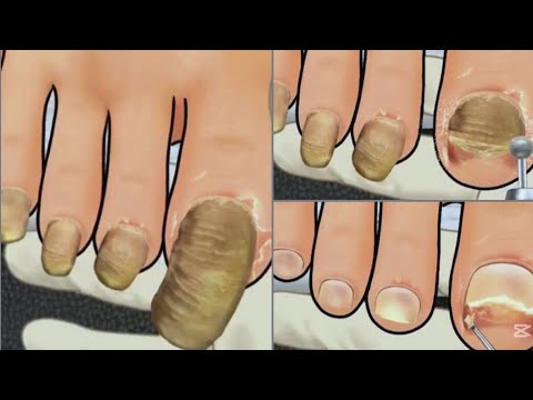 treatment of hard nails 《ASMR》animation