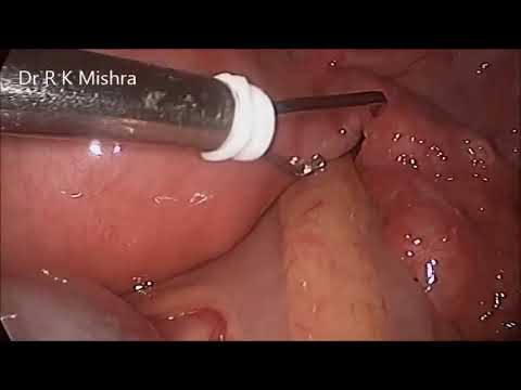 Dr. R.K. Mishra demonstrating Female Laparoscopic Sterilization by Falope Ring
