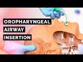 Oropharyngeal Airway Insertion Techniques