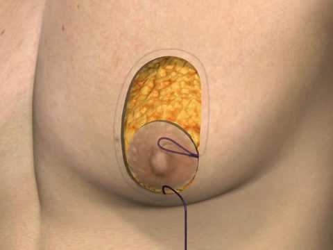 Anatomical illustration of breast tissue and surgery.