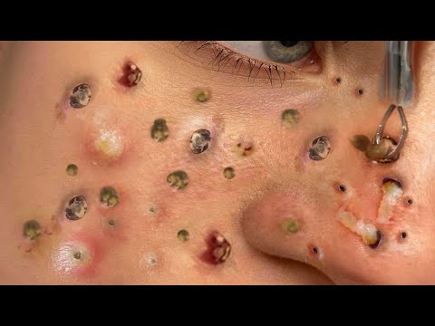 Blackhead Removal With Sac Dep Spa @100074046