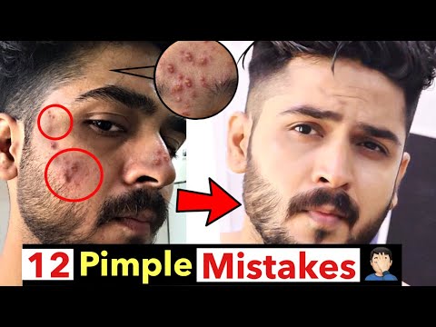 12 Worst Acne Mistakes that Damage Your Face/Skin | Mistakes that Cause Face Pimples