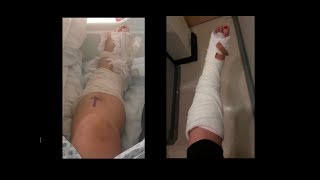 I broke my talus rock climbing -- 5: The Hospital Experience