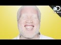 Understanding Albinism
