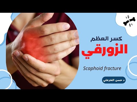 كسر العظم الزورقي الاسباب والعلاج