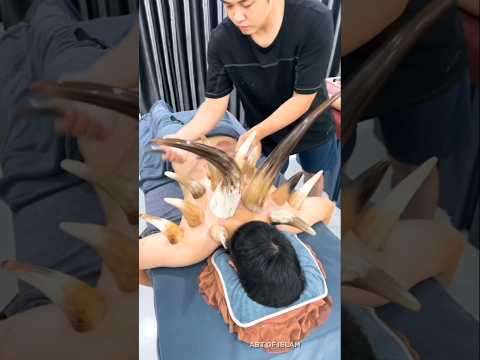 What Is Hijama In Islam ? 😱/#ytshorts #youtubeshorts #shorts #islam
