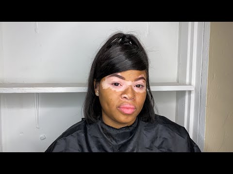 Vitiligo Make Up Cover  Up Tutorial | High School Graduation