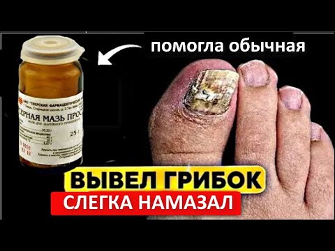 Удаляет грибок ногтей мгновенно, как ластик ! Простая советская мазь