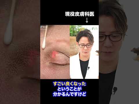 シミってレーザーで消えるんですか？現役皮膚科医が解説#shorts