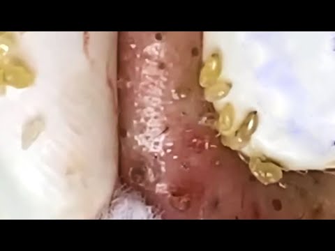 Blackheads & Whiteheads Satisfying Removal @0537