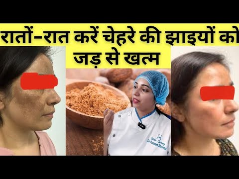 चेहरे की झाइयां दाग धब्बे करे जड़ से ठीक | Jhaiyon ka Gharelu Ilaaj | Pigmentation Treatment At Home