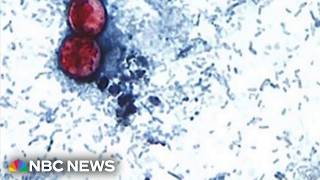 YouTube video thumbnail: Cases of Illness That Causes Explosive Diarrhea on the Rise Across the U.S.