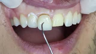 فينير اسنان تجميلي لتصحيح لون واعوجاج الاسنان