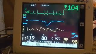 ECG during a period of Atrial Fibrillation 