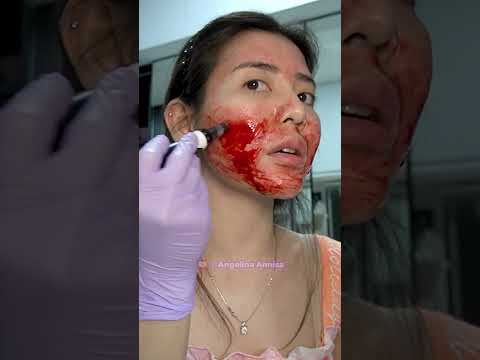 TREATMENT DERMAPEN 26X - 1 HARI 2X TREATMENT LANGSUNG😱😱