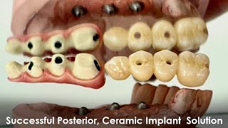 Successful Posterior Cosmetic Implant Solution