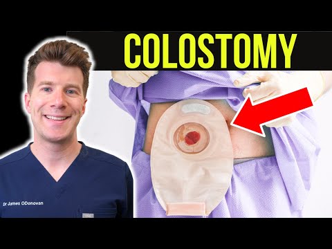 Doctor explains Colostomy (Stoma)