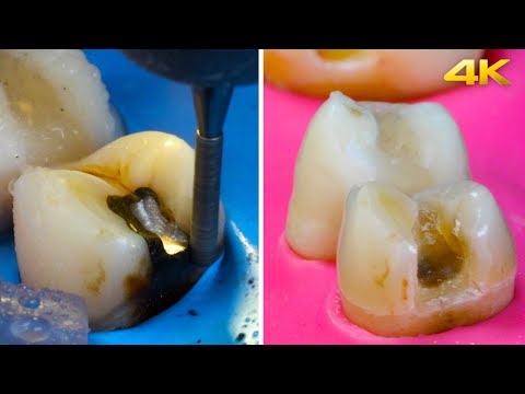 AWESOME Silver Filling Removal!
