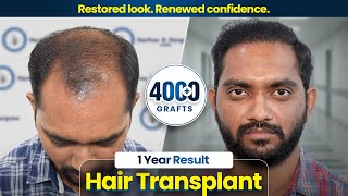 Grade 5 Hair Transplant | 4380 Grafts | 1 Year Results | Before & After Transformation