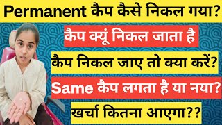 Dental Cap बार-बार निकलता है? जानिए इसकी वजह और इलाज |Teeth Cap Coming Out? Reasons And Cost ?