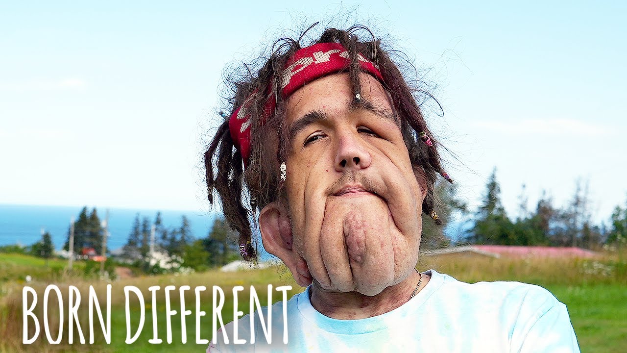 The social media star with giant facial tumours - born different
