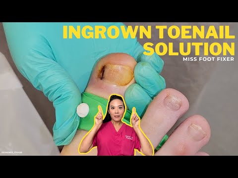 Instant Solution for Painful Ingrown Toenail