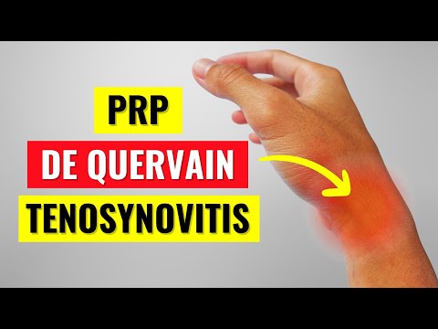 PRP Injections for De Quervain's Tenosynovitis