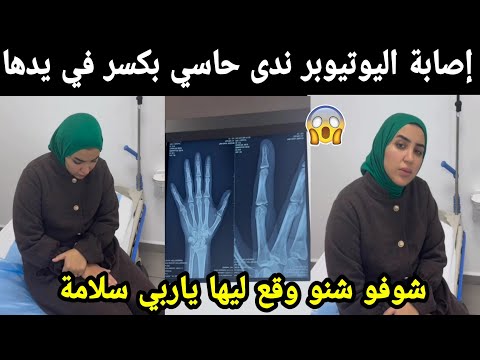 عاجل.. إصابة اليوتيوبر ندى حاسي بكسر في يدها 😱 شوفو شنو وقع ليها ياربي سلامة 🥺