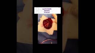 Kalpte tümör, Prof.Dr.Serdar Akgün, Serdar Akgün Tıp Videoları