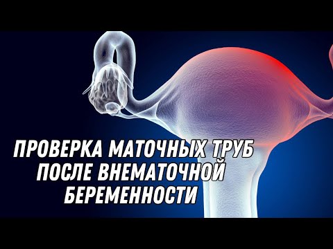 Проверка маточночных труб после внематочной беременности #doctorberezovska #olenaberezovska