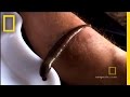 Ayurvedic Treatment with Leeches