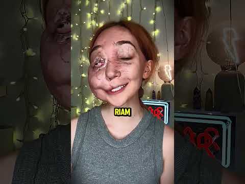 Ela foi humilhada por causa das cicatrizes, mas sua volta chocou o mundo!