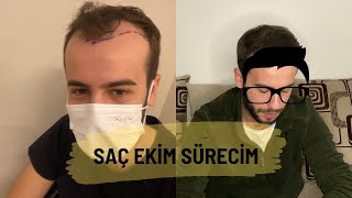 Saç Ekim Sürecim / Kelliğe Veda...