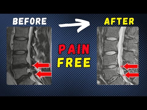 Lumbar Disc Extrusion L3 L4 & L4 L5 recovery without surgery