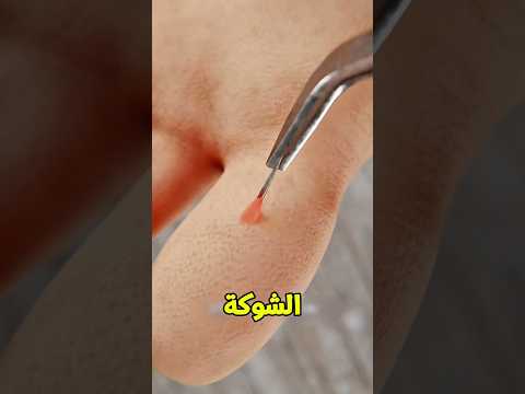 لو شوكة دخلت فيك هتعمل اية😲؟