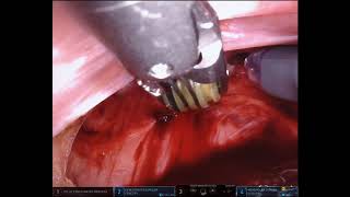Novel rectovaginal fisulta repair (robotic transabdominal approach)