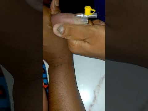 IV Cannulation Procedure technique #mbbs #shortvideo
